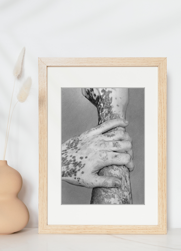 vitiligo 1